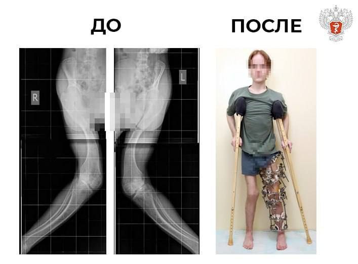 В федеральном центре Минздрава России молодому человеку исправили тяжелые деформации ног, вызванные редкой формой фосфат-диабета