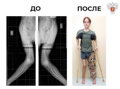 В федеральном центре Минздрава России молодому человеку исправили тяжелые деформации ног, вызванные редкой формой фосфат-диабета