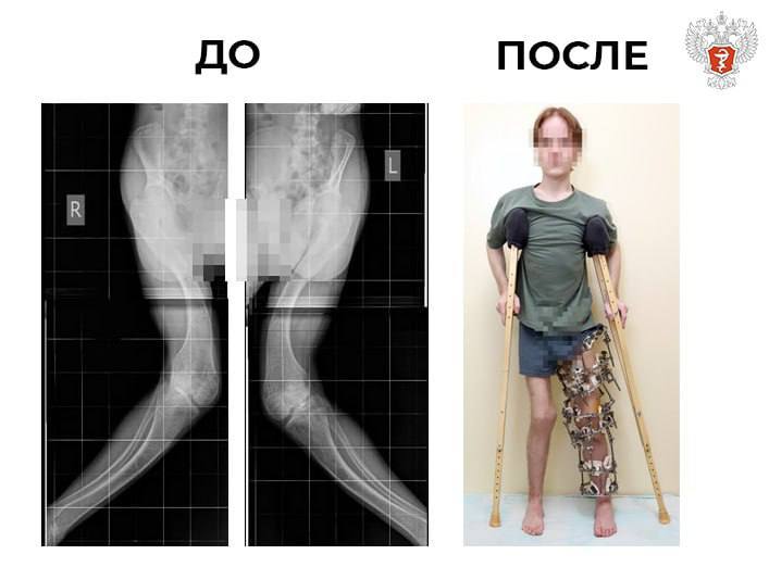 В федеральном центре Минздрава России молодому человеку исправили тяжелые деформации ног, вызванные редкой формой фосфат-диабета