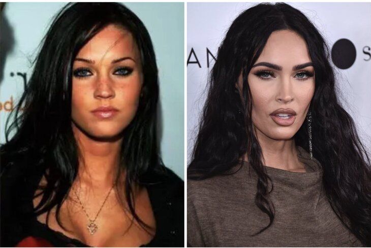 Звезды и эстетическая хирургия: Как операции меняют облик известных женщин