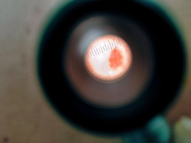 Кировские врачи проведут бесплатную диагностику родинок