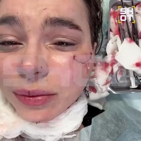 Косметологу из Кирова разрезала лицо до кости неизвестная девушка в ночном клубе в Казани после концерта t.A.T.u