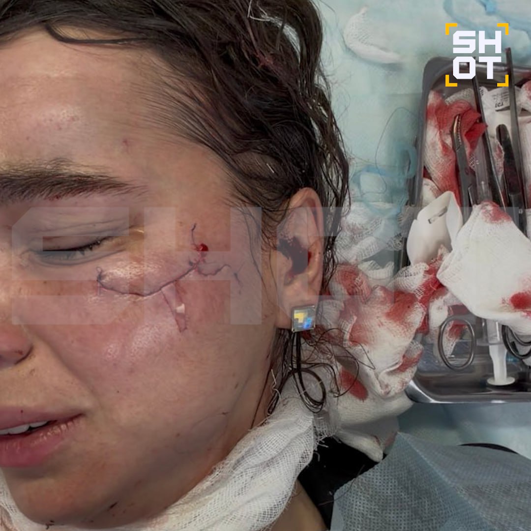 Косметологу из Кирова разрезала лицо до кости неизвестная девушка в ночном клубе в Казани после концерта t.A.T.u Косметологу из Кирова разрезала лицо до кости неизвестная девушка в ночном клубе в Казани после концерта t.A.T.u