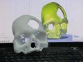 Кировские травматологи применяют 3D-печать для подготовки к операциям