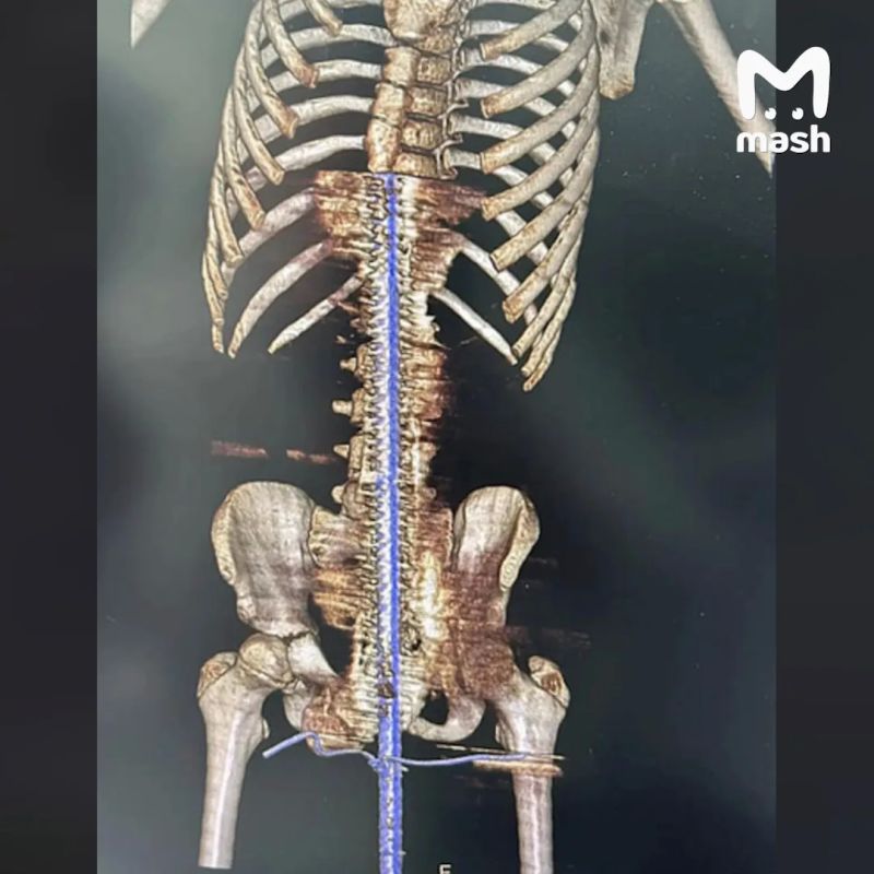 12-летний любитель прыгать по гаражам упал на полуметровый металлический штырь в Кировской области — палка проткнула мальчика насквозь, остановившись в сантиметре от сердца